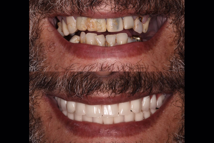 Tipos de implante dentário - Overdenture