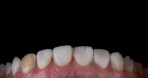 erosão dental tratamento