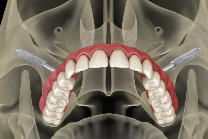 quanta custa um implante dentario