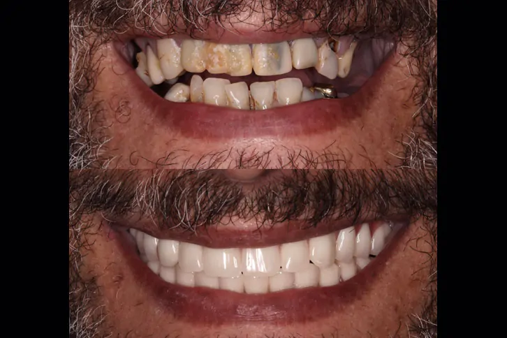 Tipos de implante dentário - Overdenture
