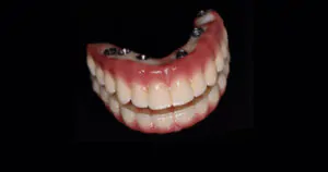 Tipos-de-implante-dentário-descubra-quais-são-as-opções